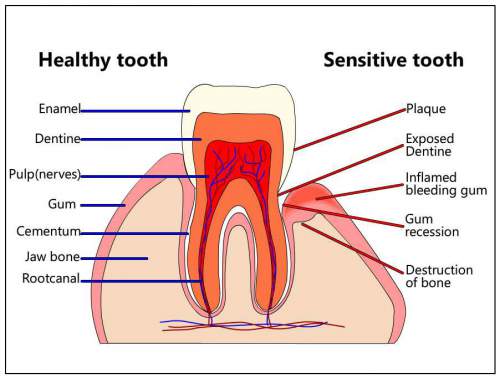 Sensitive Tooth